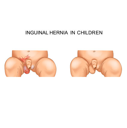 https://www.southerngem.in/images/inguinal-hernia.jpg